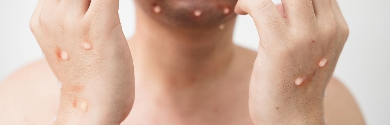 Variola maimutei: Simptome, transmitere, preventie si tratament