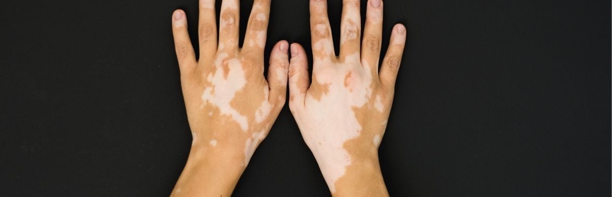 Vitiligo: Ce este, cum se manifesta, solutii de tratament