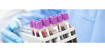 Calcitonina, un hormon implicat in reglarea metabolismului calciului. Ce trebuie sa retii