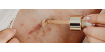 Tips and tricks: Cum poti scapa de cicatrici