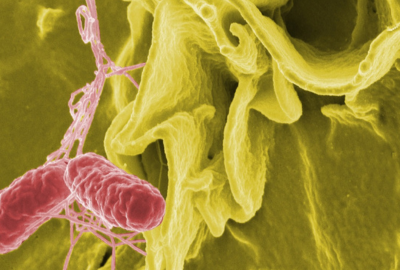 Actinomicoza, o infectie care formeaza abcese si fistule: de ce apare si cum o putem evita