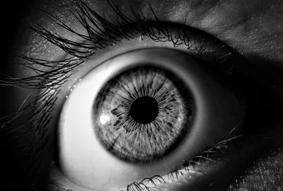 Keratocon: O afectiune oculara care afecteaza forma corneei
