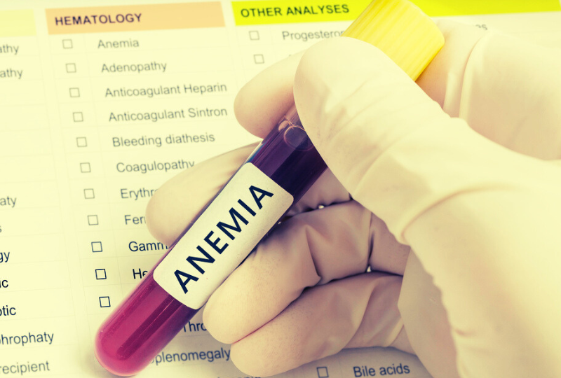 Anemia pernicioasa: simptome, cauze, optiuni de tratament