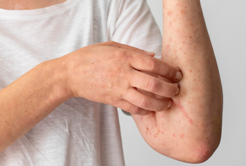 Eritrodermia: Cum identifici aceasta boala, preventie si optiuni de tratament