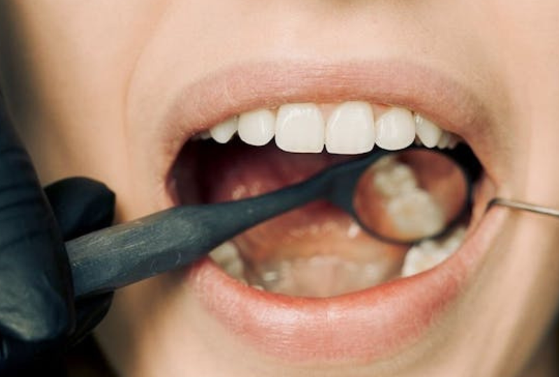 Pericoronarita: Cauze, simptome asociate, tratamente recomandate