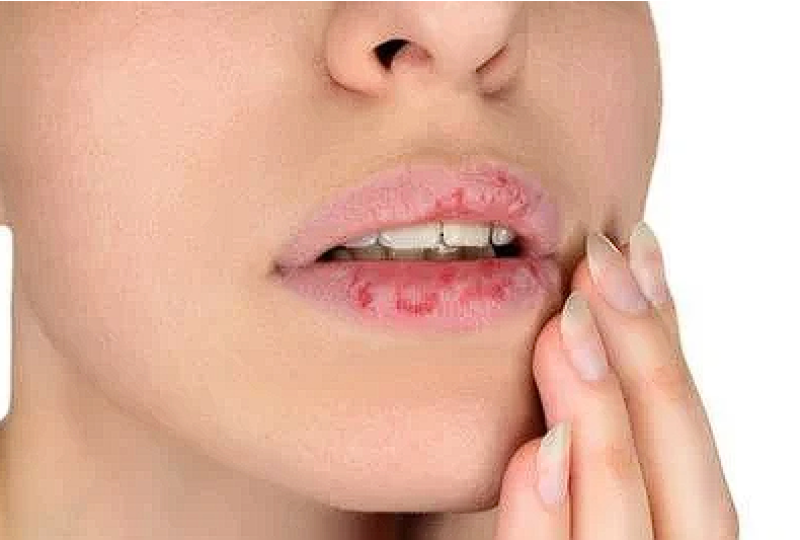 Febra Dengue: Cum recunosti simptomele, preventie si tratament