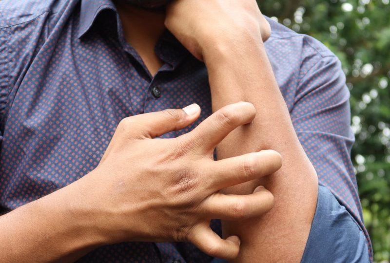 Urticaria presionala: De ce apare, cum o putem evita, tipuri de tratament