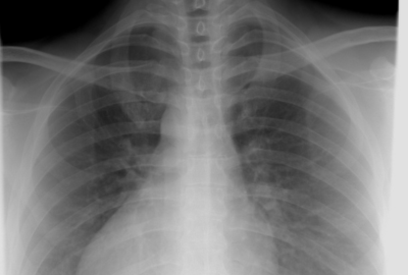 Anatomie: Ce este mediastinul si care este importanta lui pentru organism