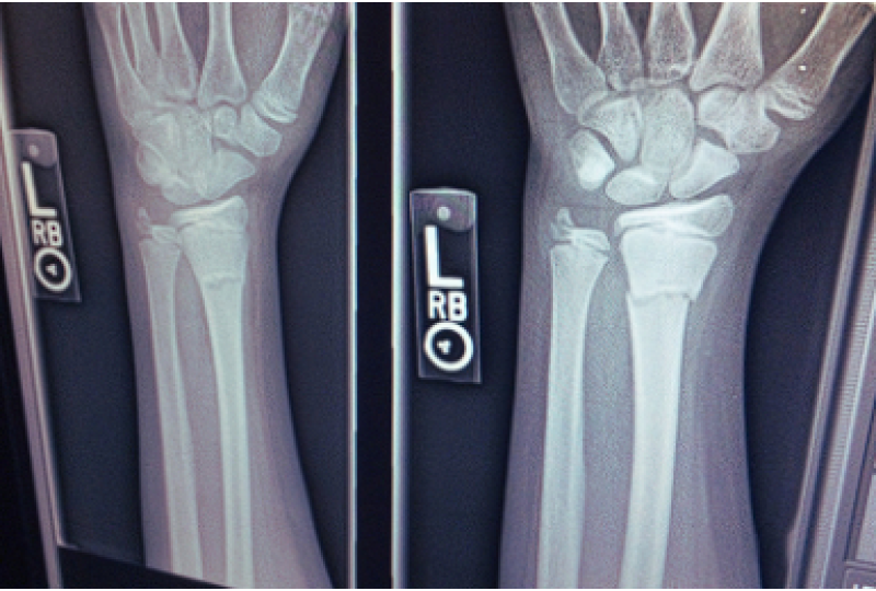Osteomalacia sau decalcifierea oaselor: De ce apare boala, cum se poate preveni