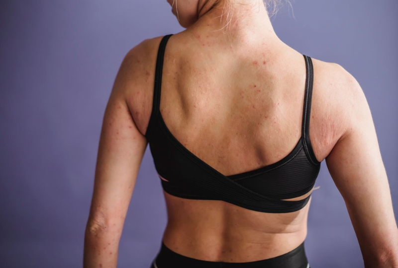 Urticaria acvagena: Ce este alergia la apa, cum ne afecteaza viata si ce trebuie sa stim despre ea