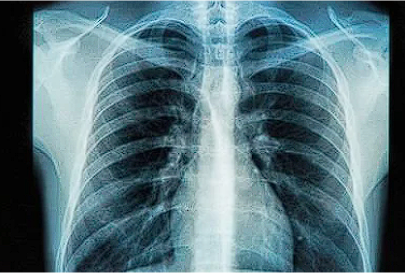Alergia la mucegai: simptome, preventie si tratament