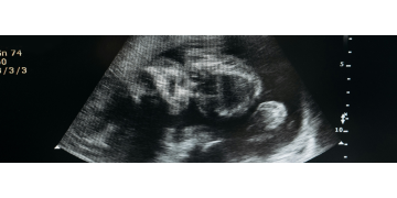 Sindromul alcoolic fetal: De ce apare, cum recunosti simptomele si cum se poate preveni