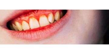 Afectiuni ale gingiilor: cum sa le prevenim, metode de tratament