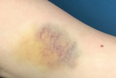 Echimozele: Cum apar, de ce apar, metode de preventie