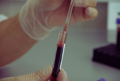 Anemia falciforma: o boala rara a sangelui care afecteaza persoanele non-caucaziene