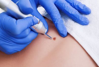 Melanomul: Ce este, cum se poate evita, complicatii ale cancerului de piele