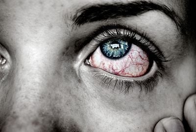 Sindromul Hermansky-Pudlak: Cum il recunosti, simptome, optiuni de tratament