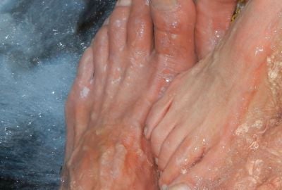 Sindromul Raynaud: De ce apare, preventie, metode de tratament