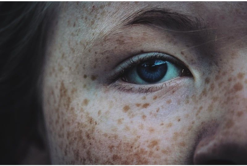 Melasma: De ce apare si cum se poate trata 