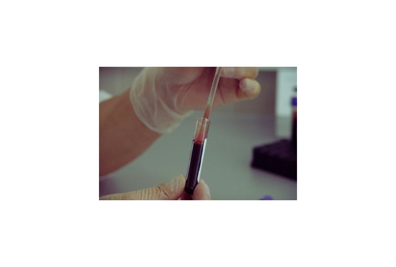 Anemia falciforma: o boala rara a sangelui care afecteaza persoanele non-caucaziene