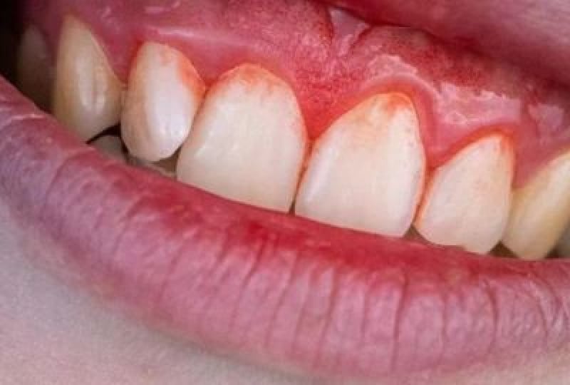 Afectiuni ale gingiilor: cum sa le prevenim, metode de tratament