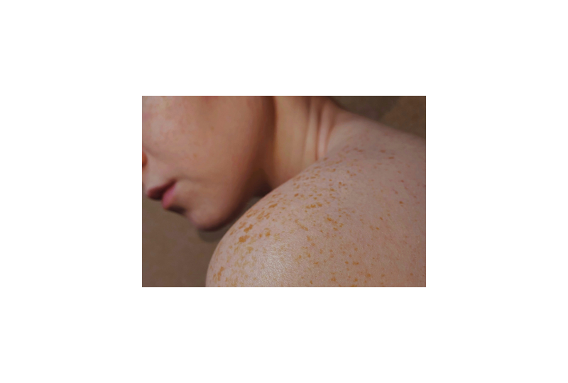 Psoriazisul pustular: cauze, simptome si optiuni de tratament