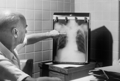 Pneumonia comunitara: cauze, simptome si tipuri de tratament tratament