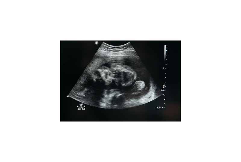 Sindromul alcoolic fetal: De ce apare, cum recunosti simptomele si cum se poate preveni