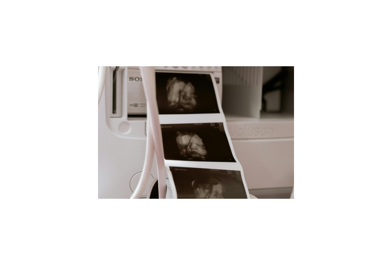 Sarcina gemelara: Cum se pune diagnostic, complicatii ale acestui tip de sarcina
