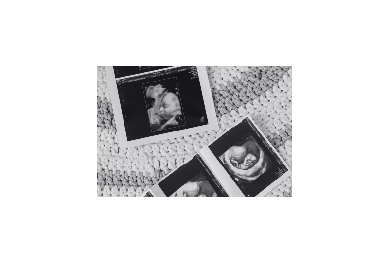 Prezentatia pelviana: Ce trebuie sa stii despre aceasta situatie care poate aparea in timpul evolutiei sarcinii