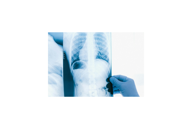 Pneumonia virala: De ce apare aceasta afectiune, cum o putem preveni, tipuri de tratament