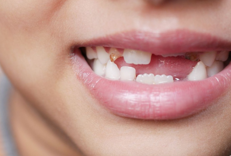 Afectiuni ale gingiilor: cum sa le prevenim, metode de tratament