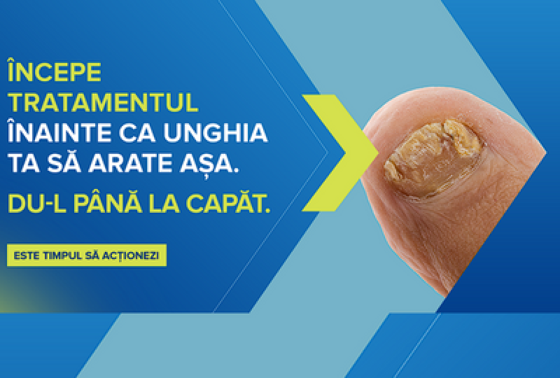 Diabetul si onicomicoza. Ce trebuie sa stii