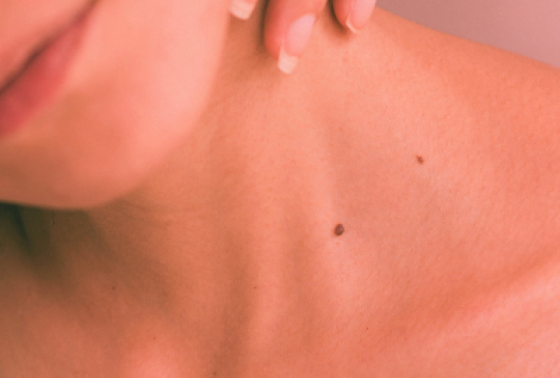 Purpura actinica: cauze, simptome si metode de preventie