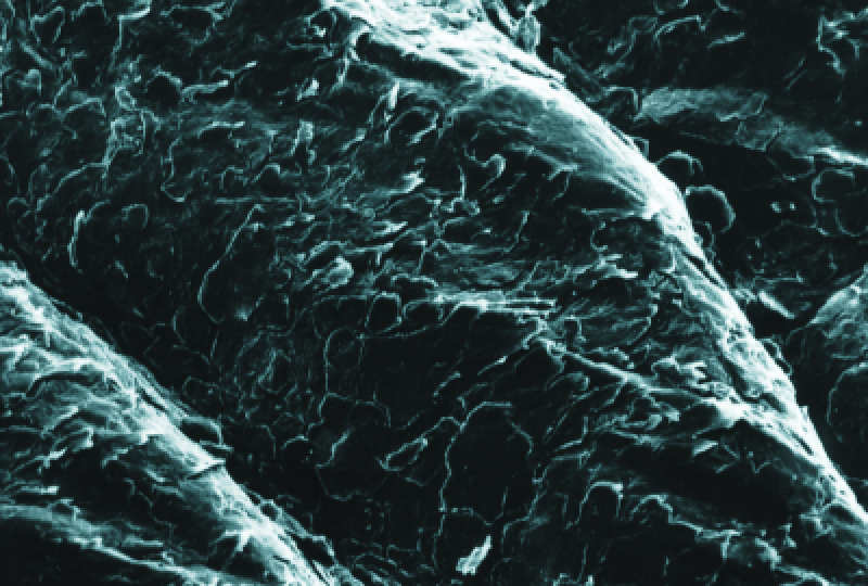 Sindromul paraneoplazic: De ce apare, tipuri, optiuni de tratament