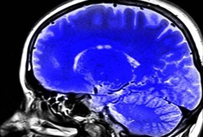 Creierul uman: Ce trebuie sa stii despre el, boli asociate cu acesta