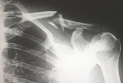 Clavicula: rol in organism, afectiuni, boli asociate
