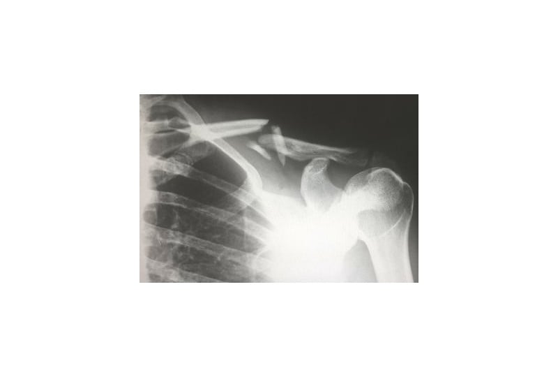 Clavicula: rol in organism, afectiuni, boli asociate
