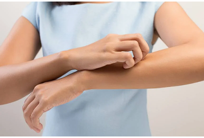 Dermatita de staza: cauze, forme, simptome, tratament