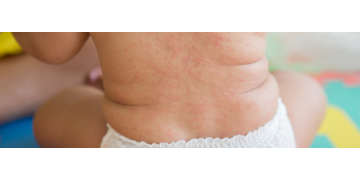 Roseola infantum: cauze, simptome, recomandari