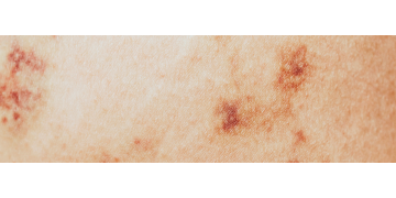 Urticaria presionala: De ce apare, cum o putem evita, tipuri de tratament