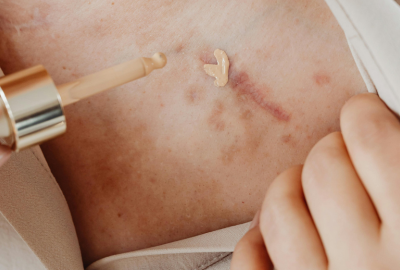 Alergiile cutanate: De ce apar si cum influenteaza stilul de viata si alimentatia eruptiile de pe piele