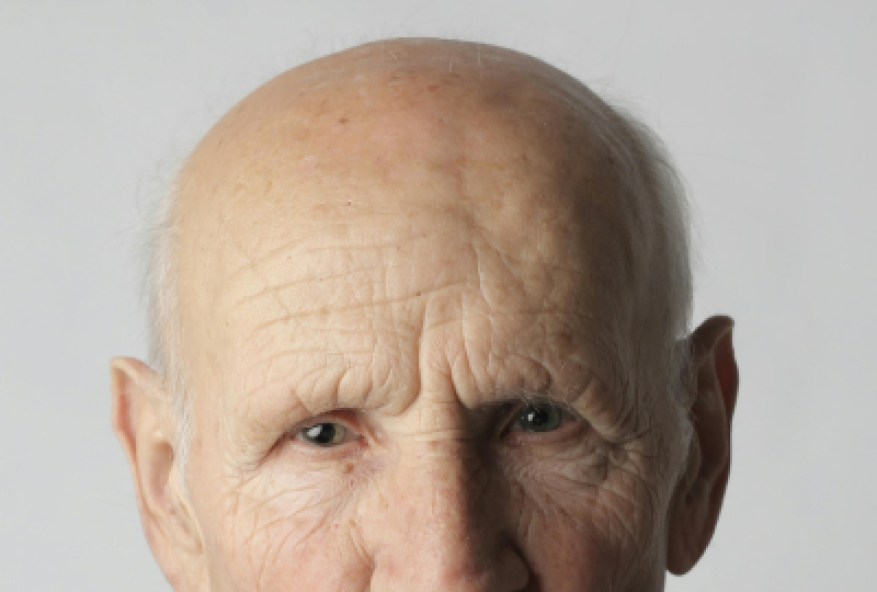 Alopecia areata: De ce apare, factori de risc, cum se poate preveni