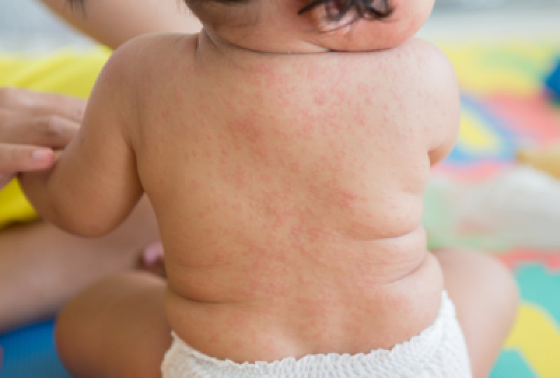 Roseola infantum: cauze, simptome, recomandari