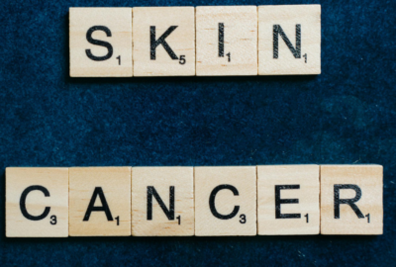 Epiteliomul bazocelular: Cum recunosti aceasta afectiune dermatologica, preventie si optiuni de tratament