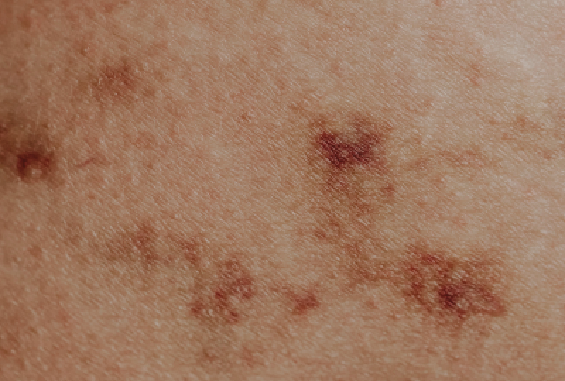 Urticaria presionala: De ce apare, cum o putem evita, tipuri de tratament