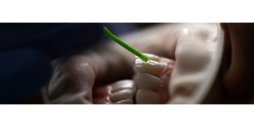 Periutele interdentare: Secretul unei igiene orale complete. Cum le alegem