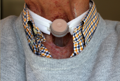Cancerul pulmonar: Tipuri, factori de risc si optiuni de tratament