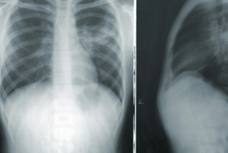 Radiografia toracica:  Cand se recomanda aceasta metoda de investigatie, ce trebuie sa stim