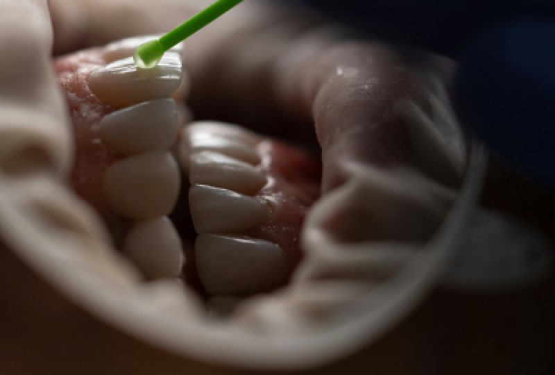 Periutele interdentare: Secretul unei igiene orale complete. Cum le alegem